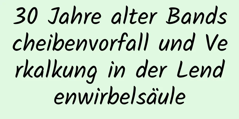 30 Jahre alter Bandscheibenvorfall und Verkalkung in der Lendenwirbelsäule