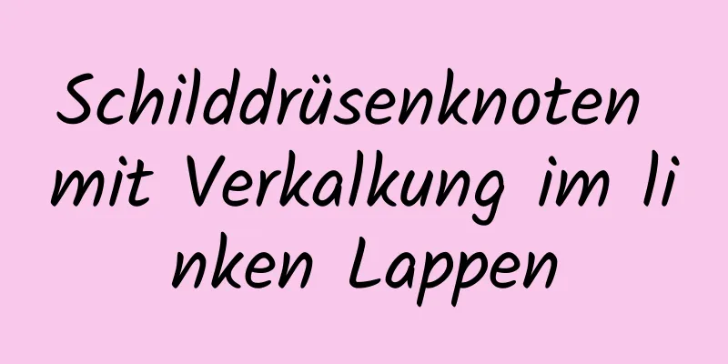Schilddrüsenknoten mit Verkalkung im linken Lappen